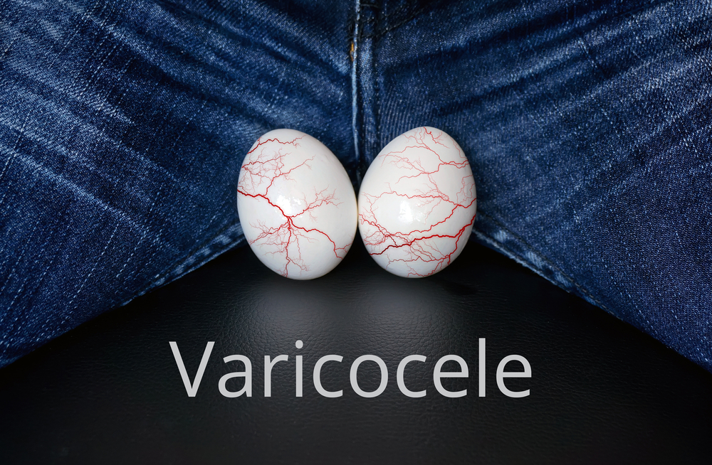 Varicocele