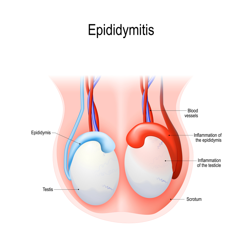 Epididymitis