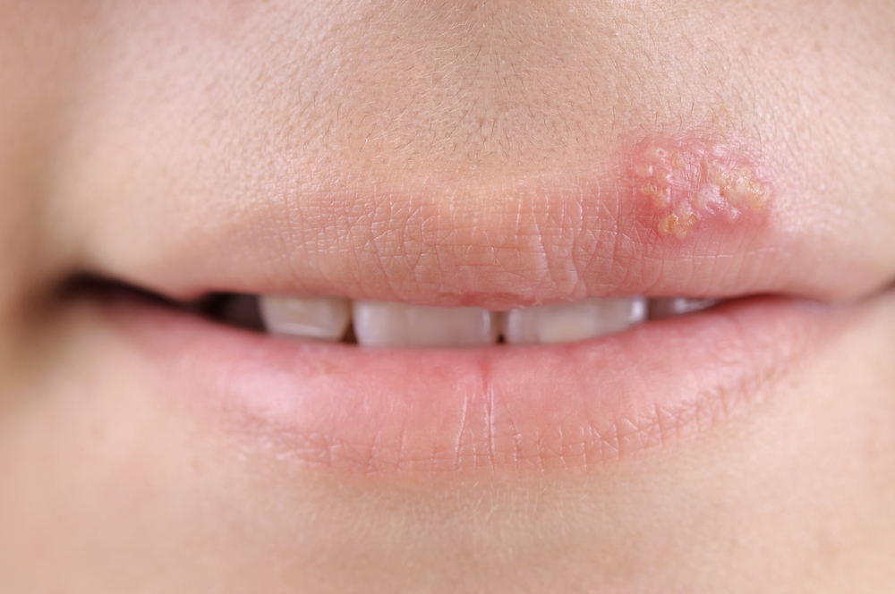 cold sore blister on upper lip