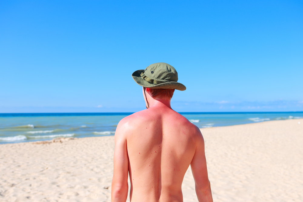 beach and sunburn