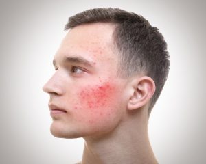 adult acne in men